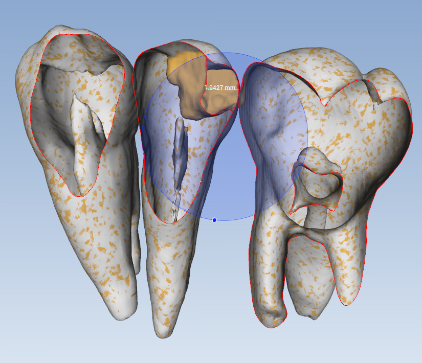 #4DO axial wall depth