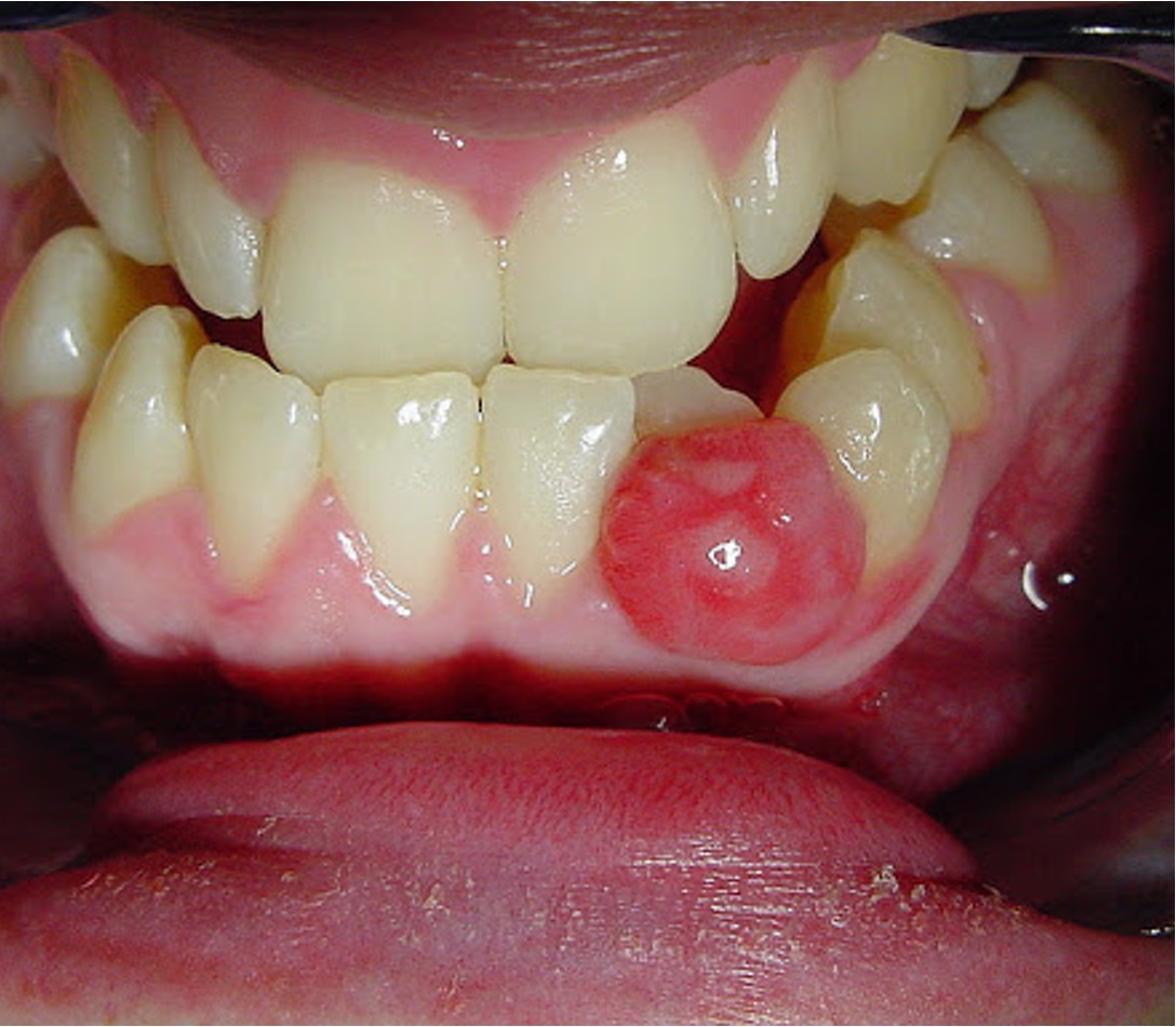 oral pathology